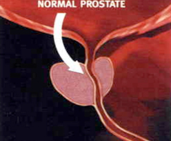 전립선 비대증이 생기는 과정01
