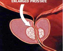 전립선 비대증이 생기는 과정02