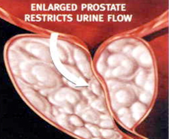 전립선 비대증이 생기는 과정03