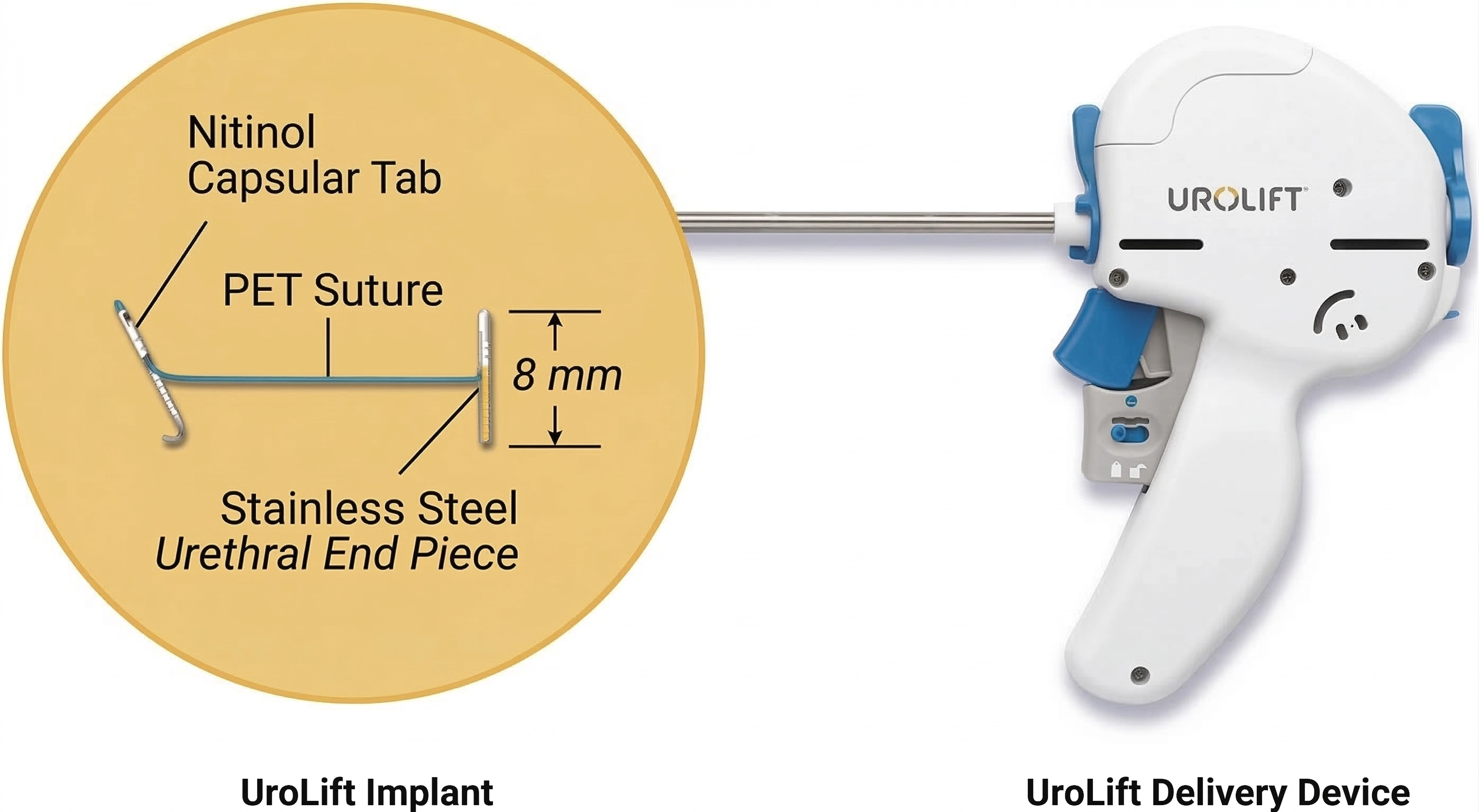 Urolift Implant